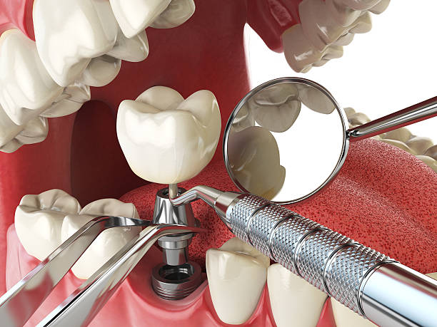 Best Cracked Tooth Emergency Dentist  in Dunlap, OH